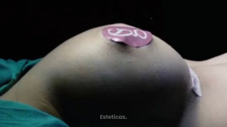 Implantes mamarios no hay una única opción para todas - Dr. Sebastián Gallo