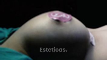 Implantes mamarios no hay una única opción para todas - Dr. Sebastián Gallo