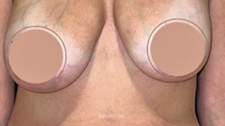 Mastopexia - Dr. Honorio Labaronnie
