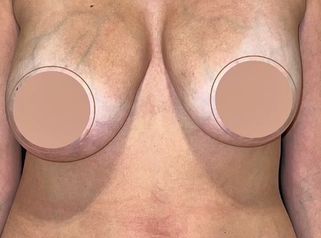 Mastopexia - Dr. Honorio Labaronnie