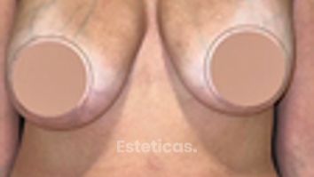 Mastopexia - Dr. Honorio Labaronnie