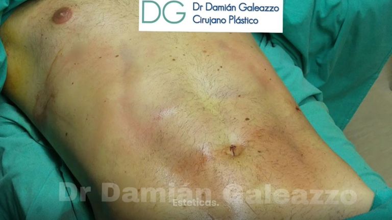 Lipoescultura con marcación abdominal.