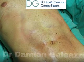 Lipoescultura con marcación abdominal.