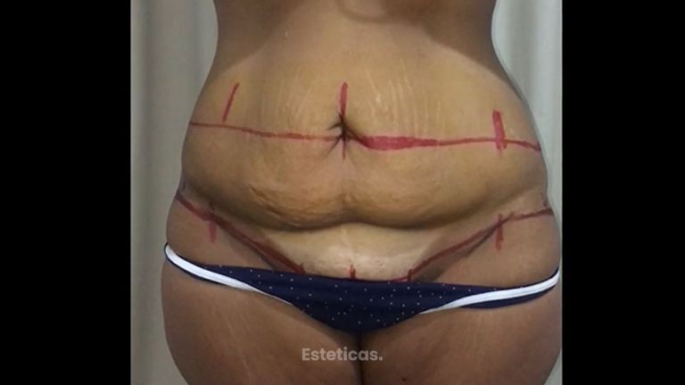 Dermolipectomía - Dr. Emmanuel Manavela Chiapero