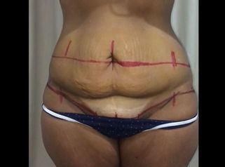 Dermolipectomía - Dr. Emmanuel Manavela Chiapero