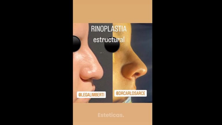 Rinoplastia - Dr. Carlos Arce