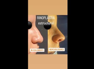 Rinoplastia - Dr. Carlos Arce