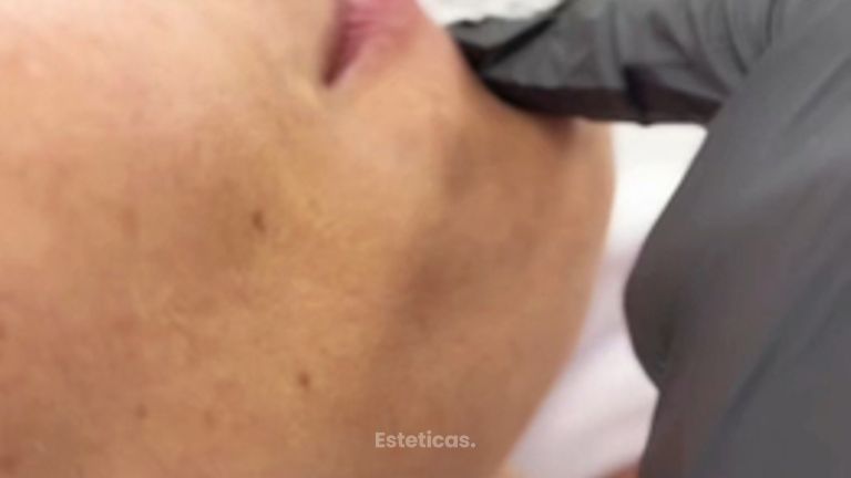 Rellenos de Labios - Dra. Maria Lucchesi Medicina Estetica