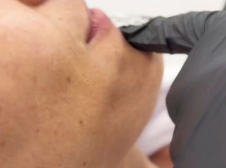 Rellenos de Labios - Dra. Maria Lucchesi Medicina Estetica
