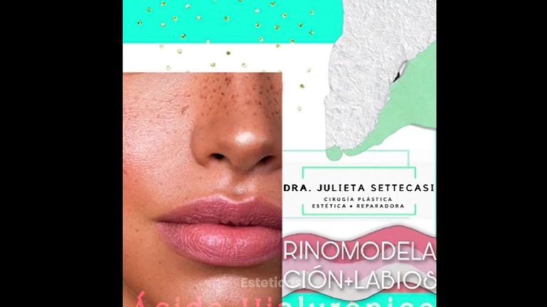 Rinomodelación + Relleno de labios - Dra. Julieta Settecasi