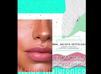 Rinomodelación + Relleno de labios - Dra. Julieta Settecasi