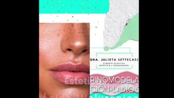 Rinomodelación + Relleno de labios - Dra. Julieta Settecasi