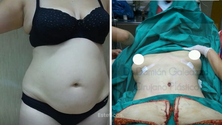 Abdominoplastía. 