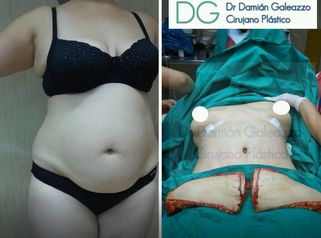 Abdominoplastía. 