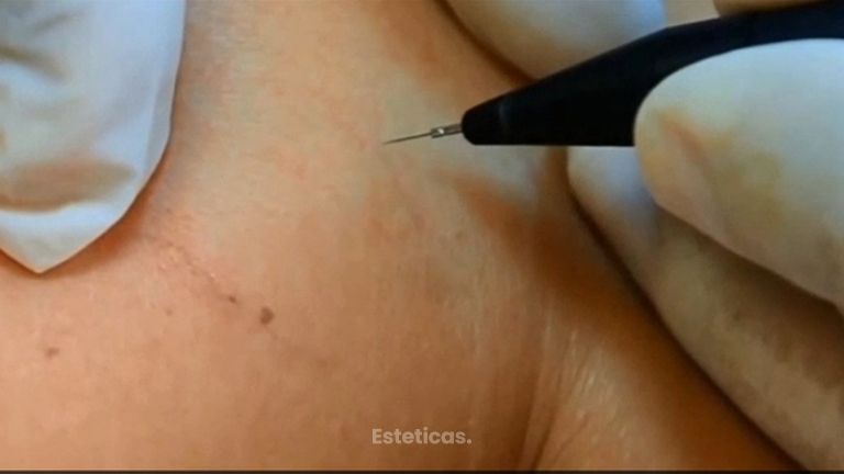 Tratamiento Cuperosis y Arañas vasculares.