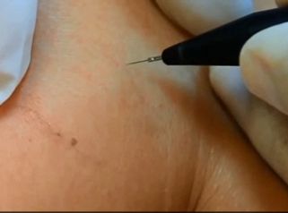 Tratamiento Cuperosis y Arañas vasculares.