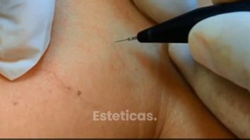 Tratamiento Cuperosis y Arañas vasculares.