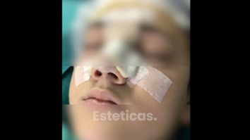 Rinoplastia