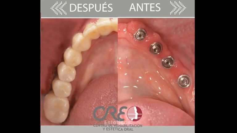Implantes dentales - Clínica Creo