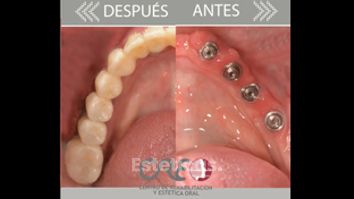 Implantes dentales - Clínica Creo