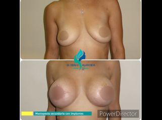 Mastopexia - Dr. Rodolfo Villavicencio