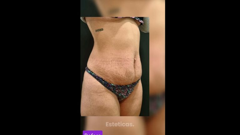 Abdominoplastia - Dra. Paola León