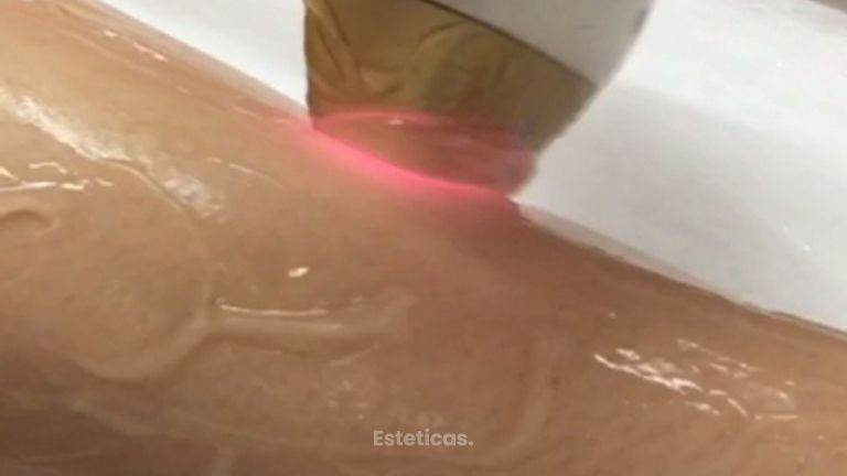 Depilación Definitiva Soprano