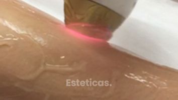 Depilación Definitiva Soprano