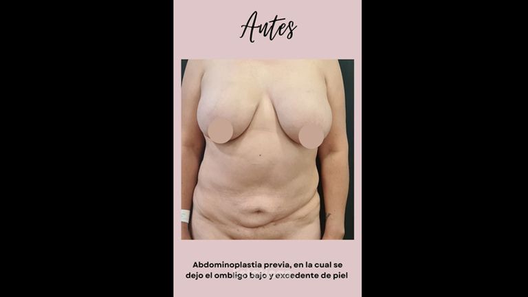 Abdominoplastia - Dra. Paola León