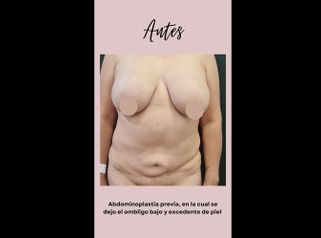 Abdominoplastia - Dra. Paola León