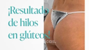 Hilos tensores - Escobar Aesthetic Clinic