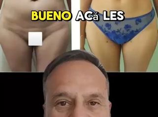 Liposucción + Mastopexia - Dr. Matias Llabres