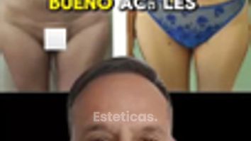 Liposucción + Mastopexia - Dr. Matias Llabres