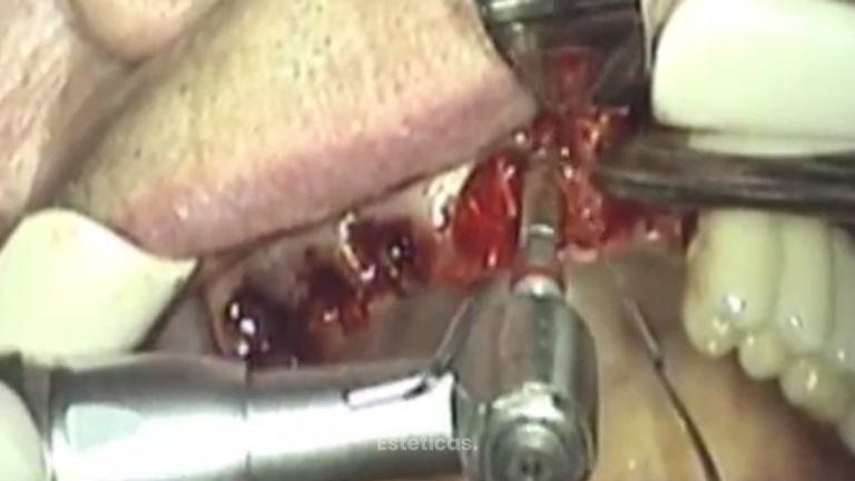 Los implantes te ayudarán a mejorar tu sonrisa