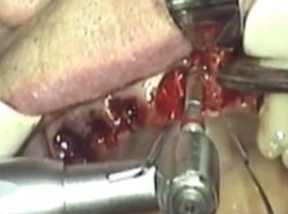 Los implantes te ayudarán a mejorar tu sonrisa