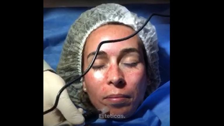 Tratamiento Rejuvenecimiento Facial con Plasma Rico en Plaquetas con técnica DERMAPEN