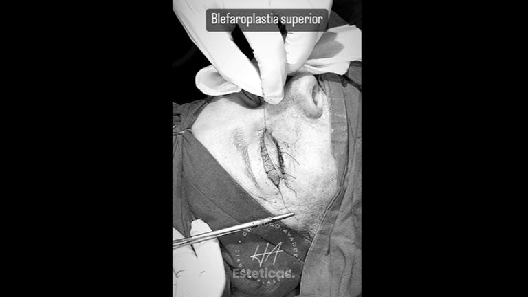 Blefaroplastia - Dr. Hugo Ayarde