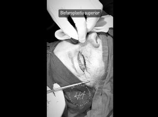 Blefaroplastia - Dr. Hugo Ayarde