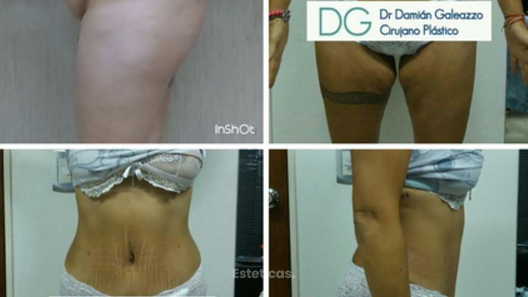 Abdominoplastía. 