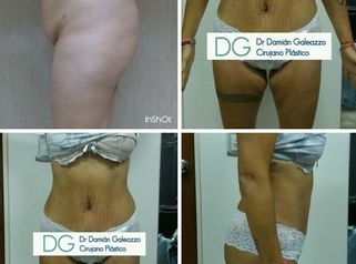 Abdominoplastía. 