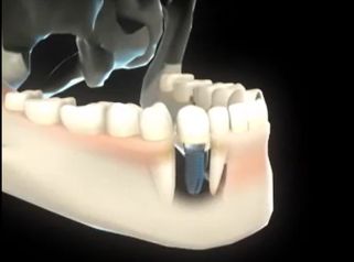 Implante dentário 
