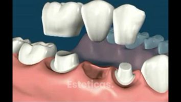 Posterior Bridge 