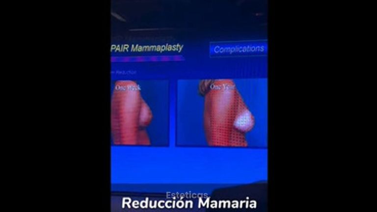 Evento Cirugía Reducción Mamaria - Dr. Alejandro J Merello Abente