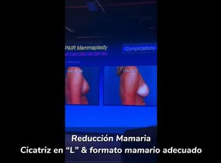 Evento Cirugía Reducción Mamaria - Dr. Alejandro J Merello Abente