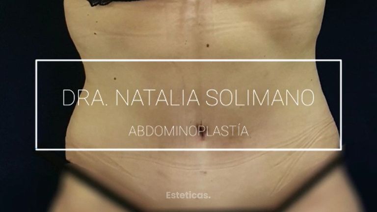 Abdominoplastia - Dra. Natalia Solimano