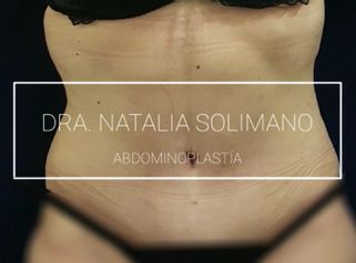 Abdominoplastia - Dra. Natalia Solimano