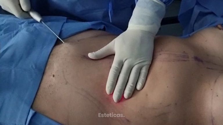 Liposucción - Dr. Javier Nicolía - Centro Médico Palmares