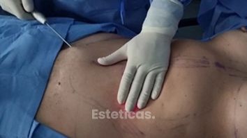 Liposucción - Dr. Javier Nicolía - Centro Médico Palmares