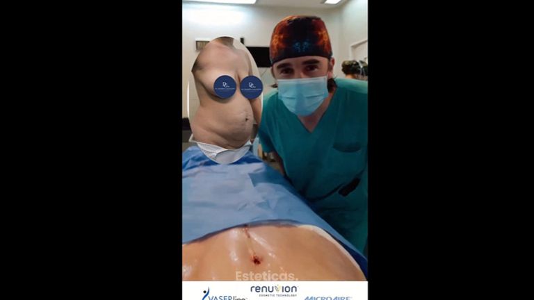 Abdominoplastia - Dr. Damián Galeazzo y Equipo