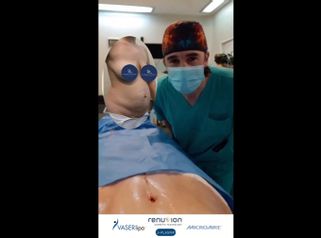 Abdominoplastia - Dr. Damián Galeazzo y Equipo